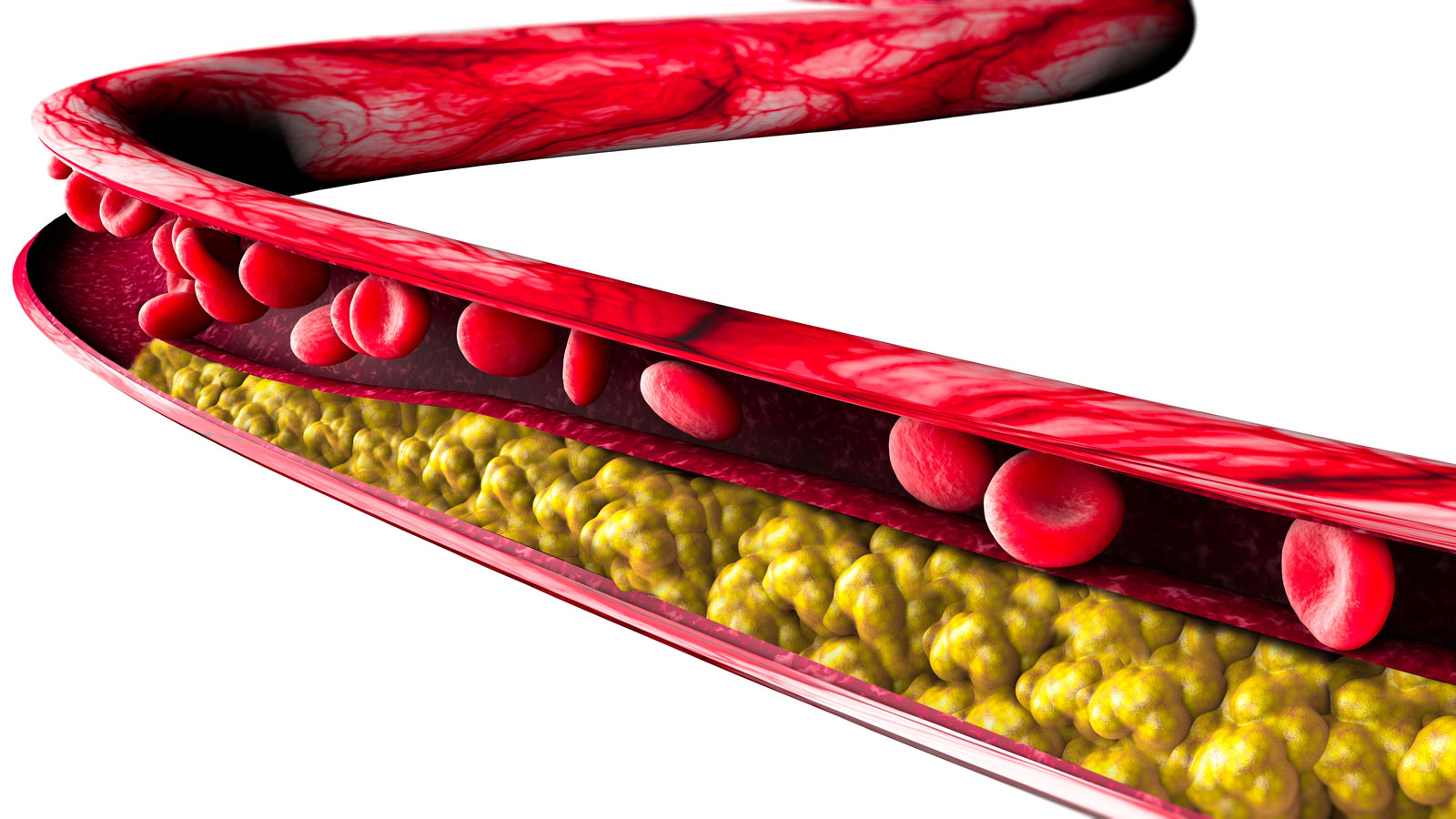 Fat, cholesterol and calcium cells build up inside the artery wall in 