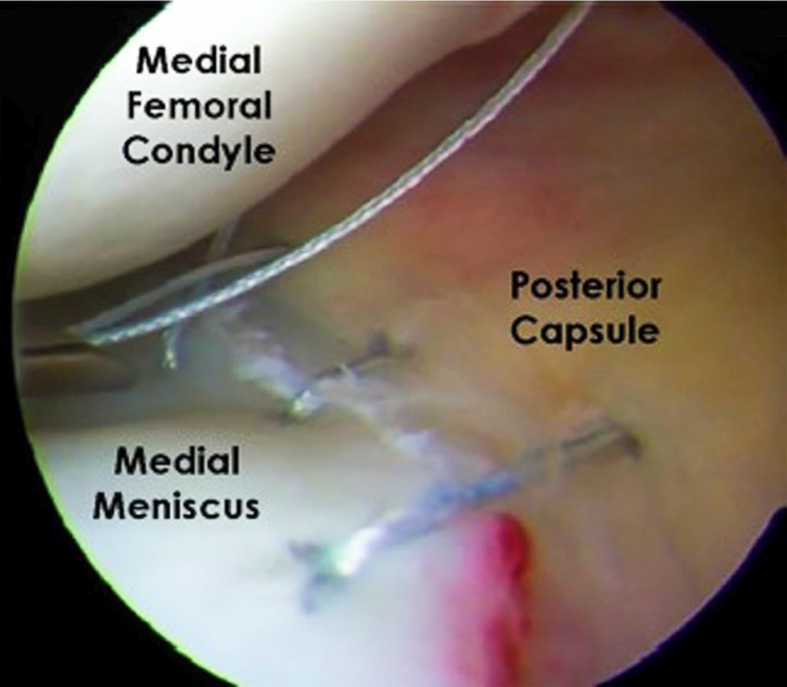 Meniscus injury